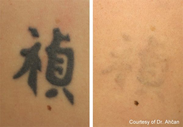 Tattoo removal