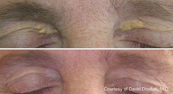 What is the treatment for xanthelasma?