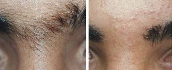 Eyebrow hair removal