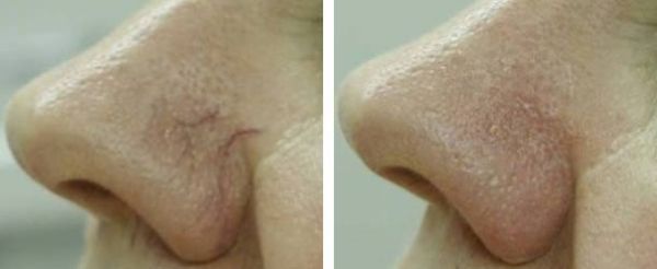 Aesthetic Facial Procedures – spider vein removal