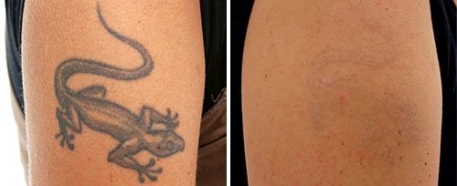 Tattoo Removal | Fotona