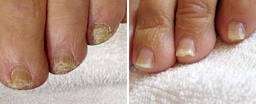 Laser Treatment for Fungal Toenails - Kansas Foot Center